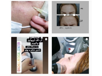 برداشتن خال و زائده‌های پوستی-کلینیک زیبایی و لیزر دکتر مجتبی عقیلی در کردکوی
