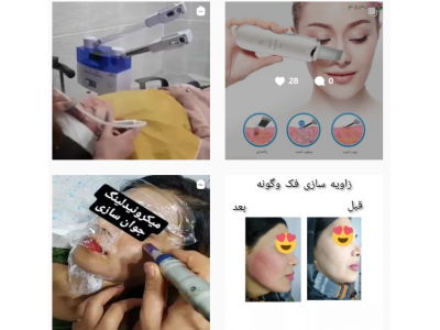 برداشتن خال و زائده‌های پوستی-کلینیک زیبایی و لیزر دکتر مجتبی عقیلی در کردکوی
